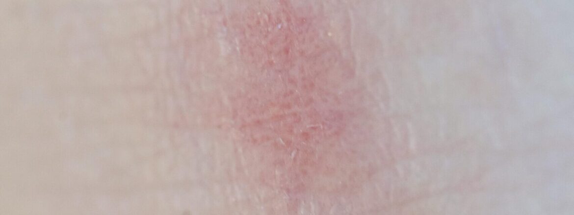 poskodovana_kozna_bariera02