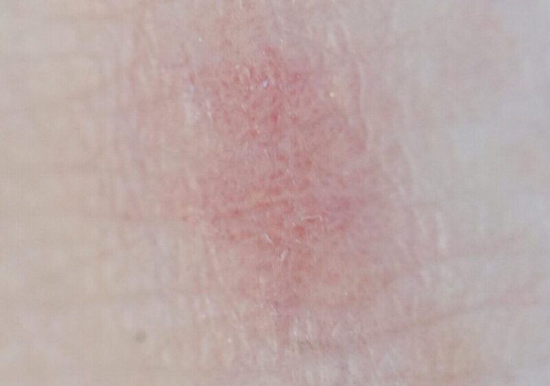 poskodovana_kozna_bariera02