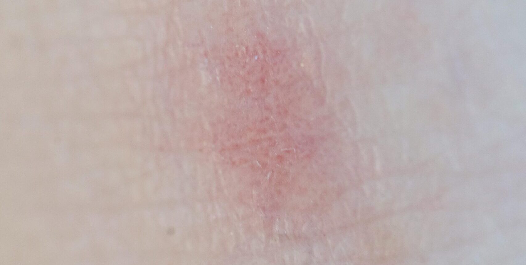 poskodovana_kozna_bariera02