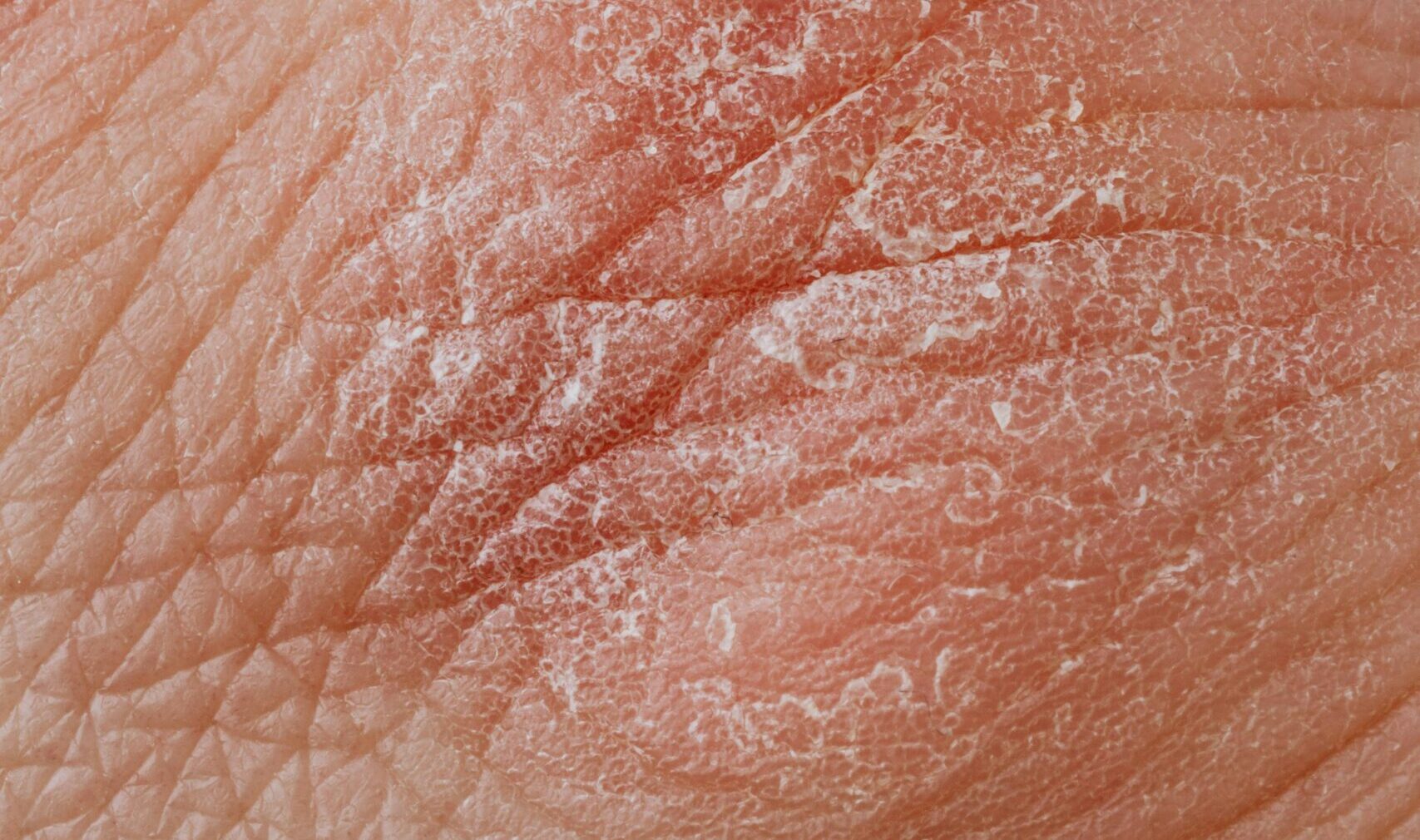 poskodovana_kozna_bariera01